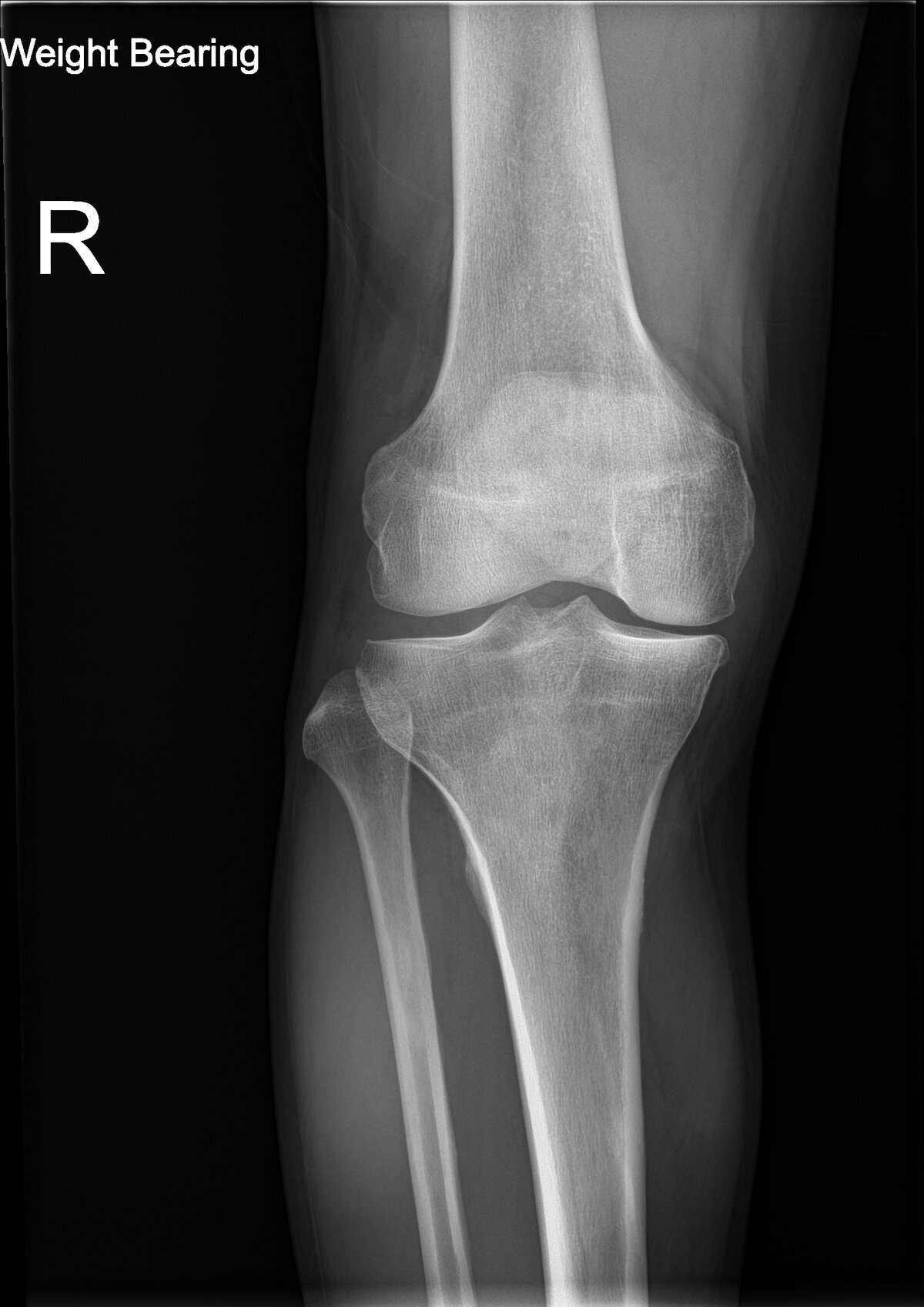 Adjunctive hyperbaric therapy for chronic refractory osteomyelitis and bone infection