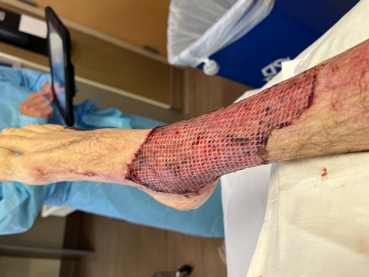 Compromised skin graft and surgical flap microvascular salvage with hyperbaric oxygen